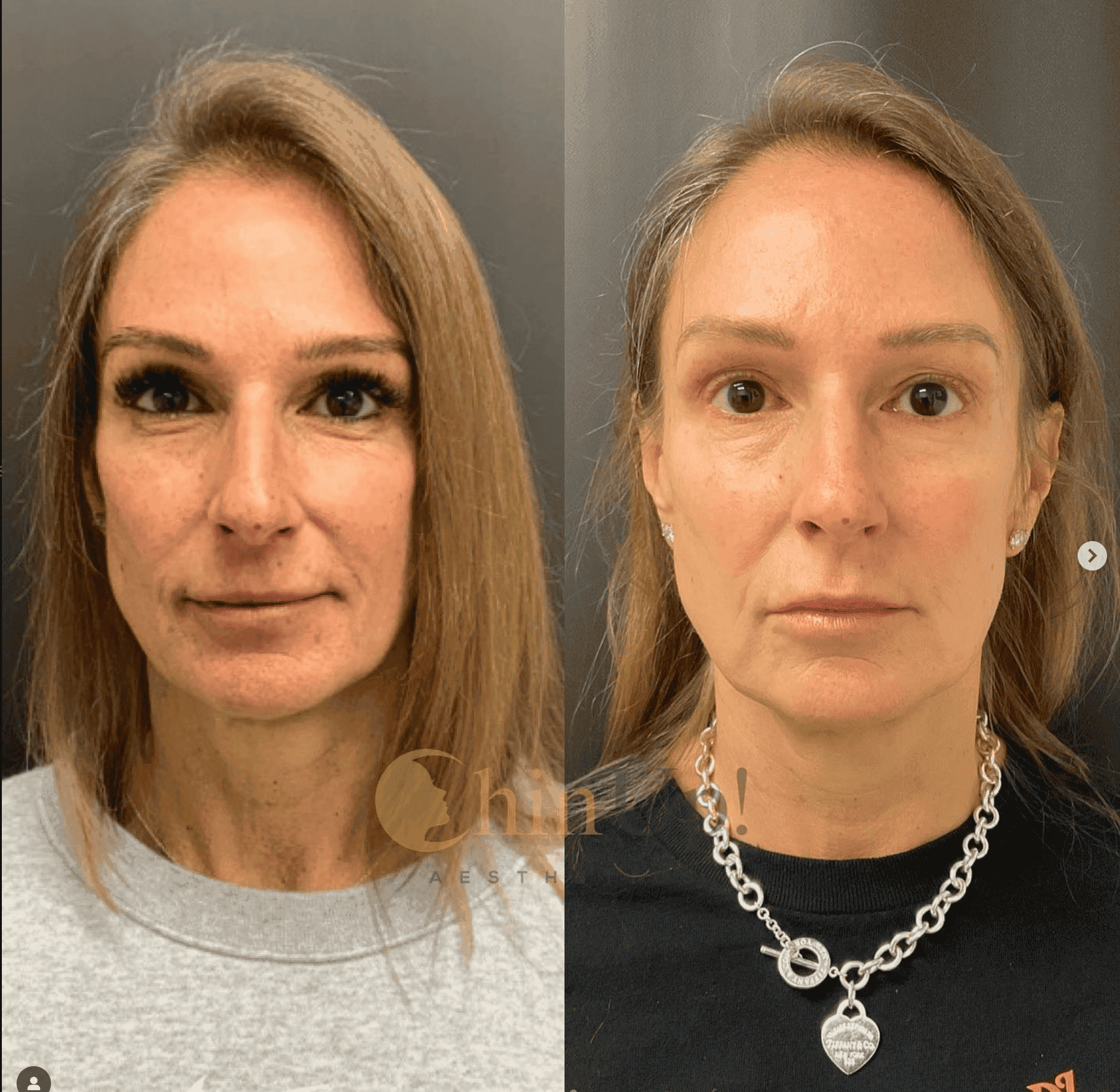 Is there anything better than this natural result that will just continue to improve with time?! Sculptra is a powerful product that contains Poly-L-Lactic Acid